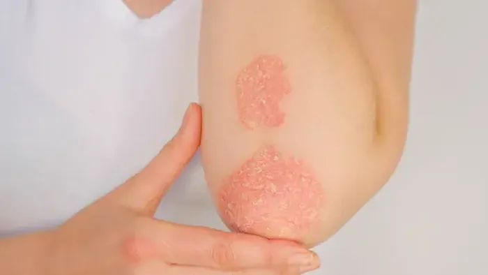 Psoriasis Causes: All You Need To Know